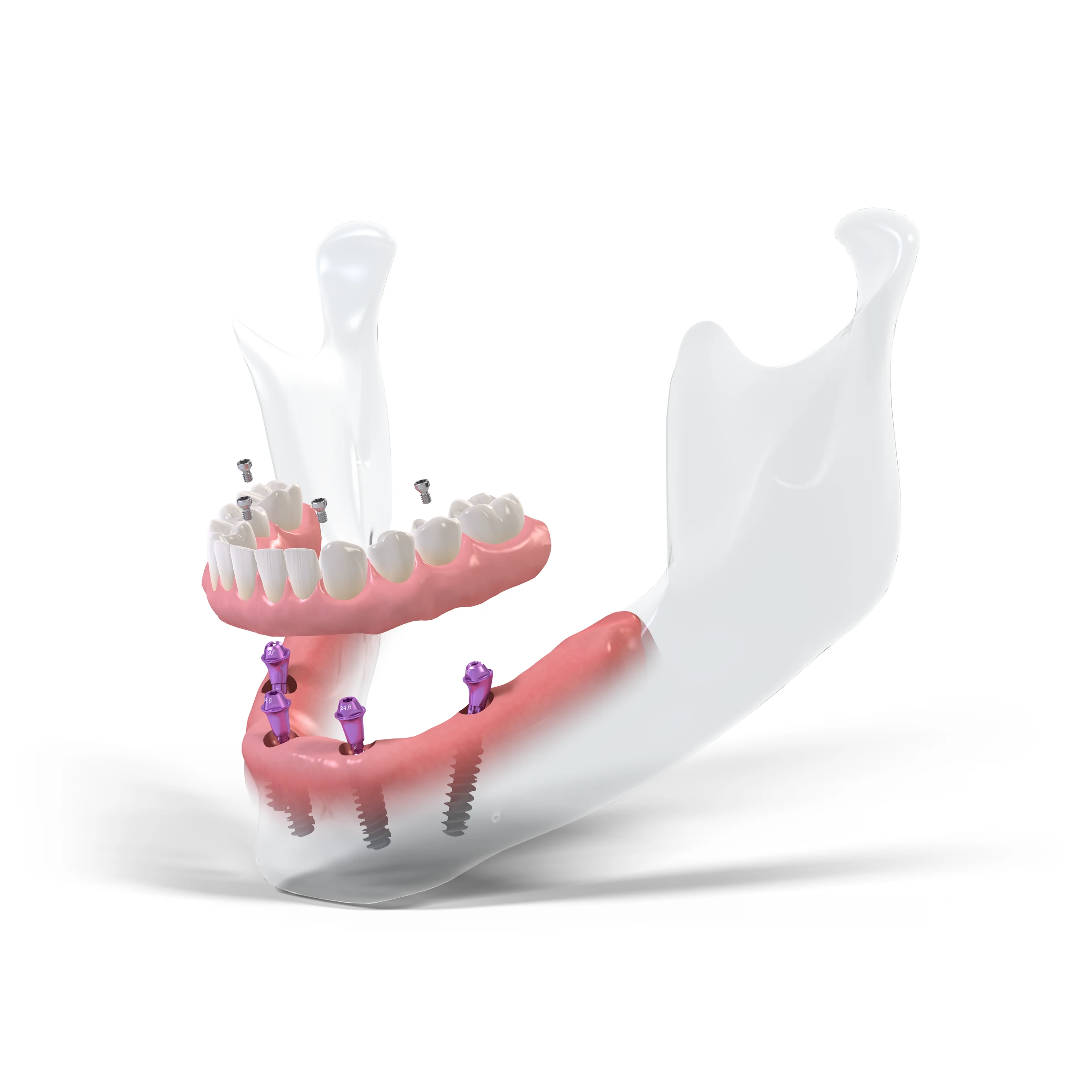 Illustration des Systems Straumann Pro Arch BLX auf Implantaten