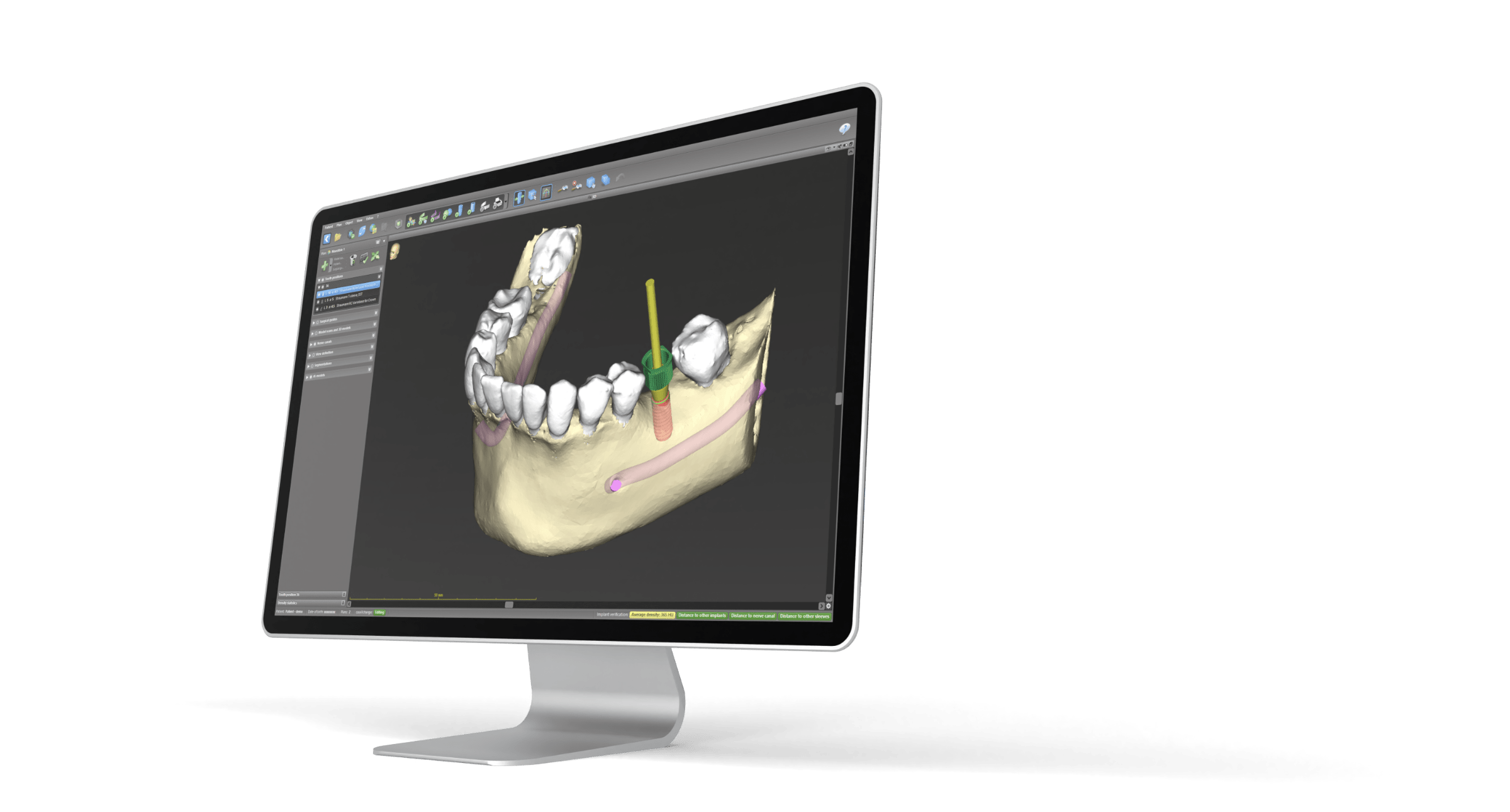 Example of implant planning in the coDiagnostiX software